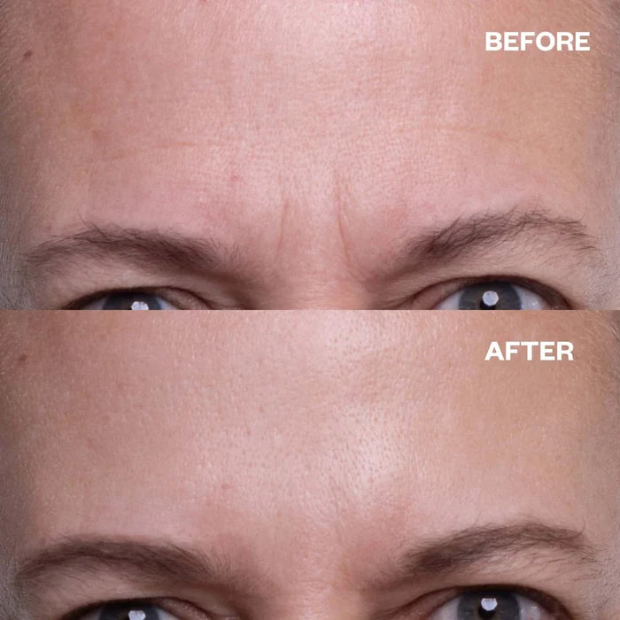 Forehead Wrinkle Patches - 2 Patches