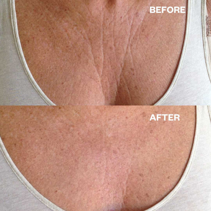 Chest Wrinkle Patch - 1 Patch